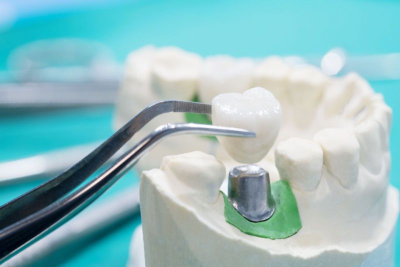 Dental Crown Procedure & Treatmebt