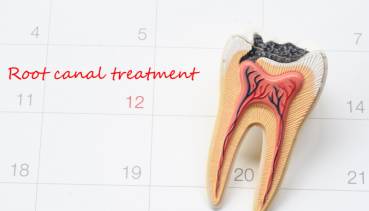 Root Canal Treatment - Appointment
